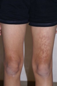Lap Toasted Skin Lap Toasted Skin